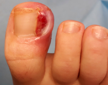 L’ongle incarné à travers les âges : où comment mieux le combattre