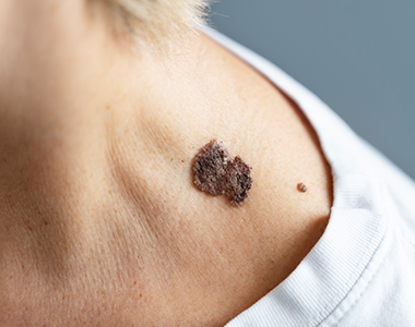 Classe virtuelle : dermatologie en pratico-pratique