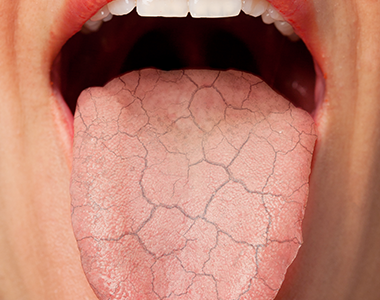 Pathologies endo buccales