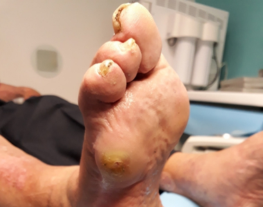 Classe virtuelle : évaluez vos pratiques de prise en charge du pied diabétique