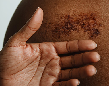 Classe virtuelle : les soirées de la dermato : cas pratiques et ordonnances types - Tome 4 : la peau noire
