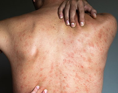 Plaintes dermatologiques inflammatoires courantes en médecine générale