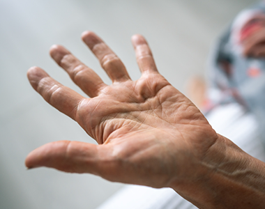 Comment s’orienter devant des paresthésies du membre supérieur ?