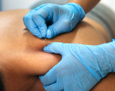 Le top 10 du Dry Needling en kinésithérapie