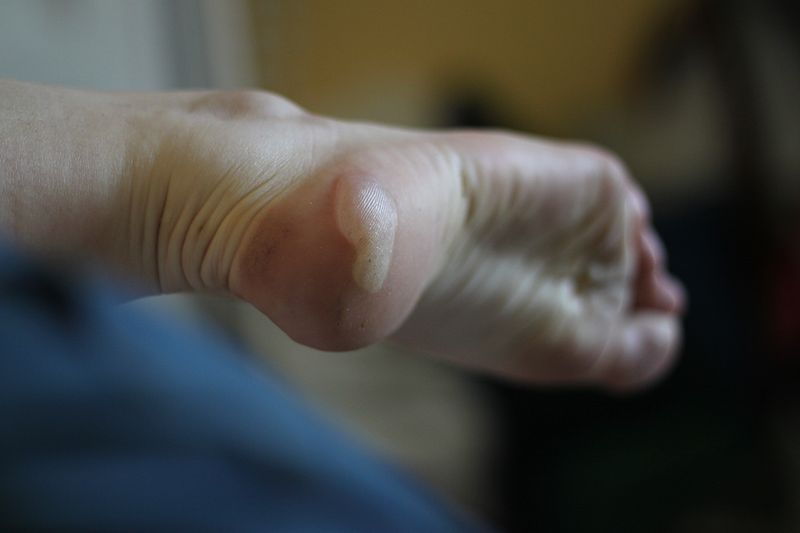 Classe virtuelle : manifestations cutanées spécifiques du coureur à pied