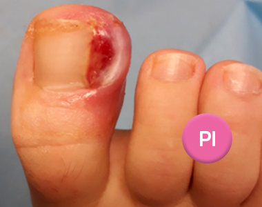 L’ongle incarné à travers les âges ou comment mieux le combattre !