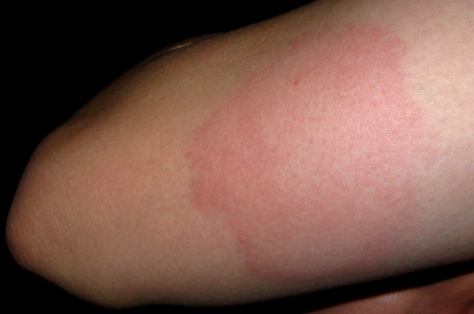 Immunothérapie et sujets âgés