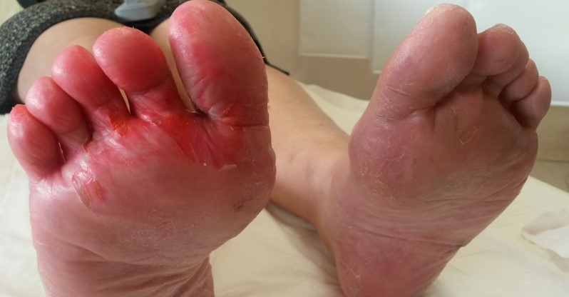 Sémiologie dermatologique du pied... du fréquent au rare, à connaitre pour la pratique !
