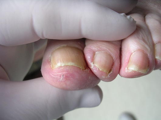Vaincre l'ongle incarné! Prise en charge et options thérapeutiques