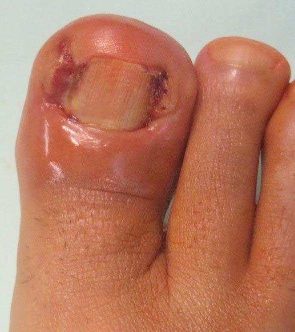 Vaincre l'ongle incarné!