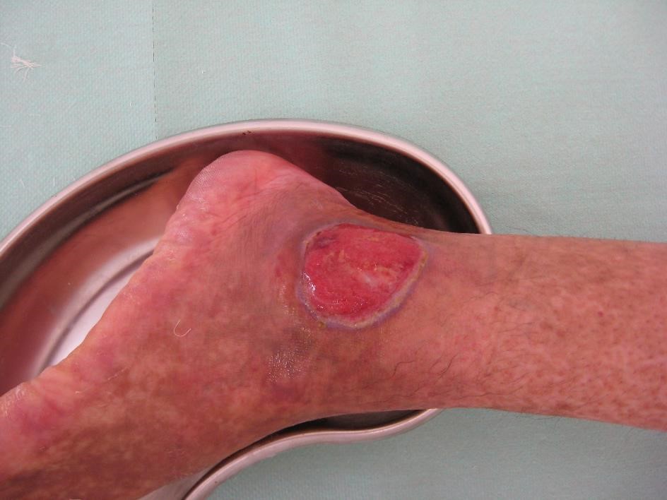 Ulcère de la jambe : diagnostic et traitement